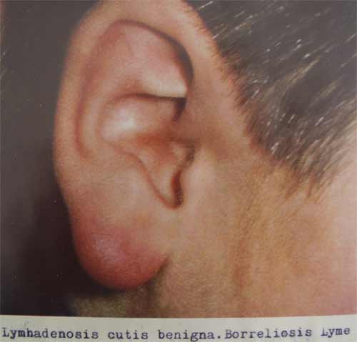 Lymhadenosis cutis benigna. Borreliosis Lyme 