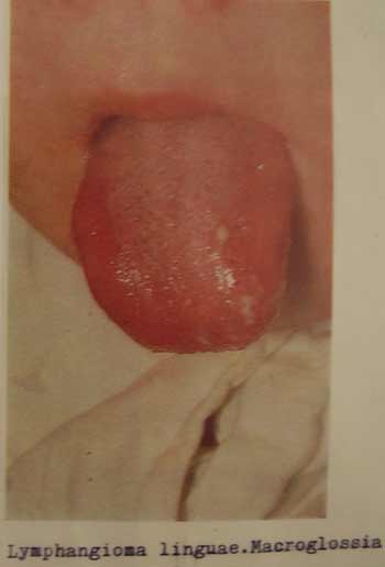 Lymphangioma linguae. Macroglossia