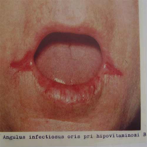 Angulus infectiosus oris pri hipovitaminozi B 