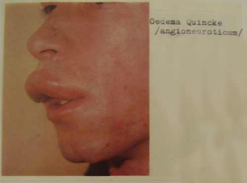 Oedema Quincke / angioneuroticum