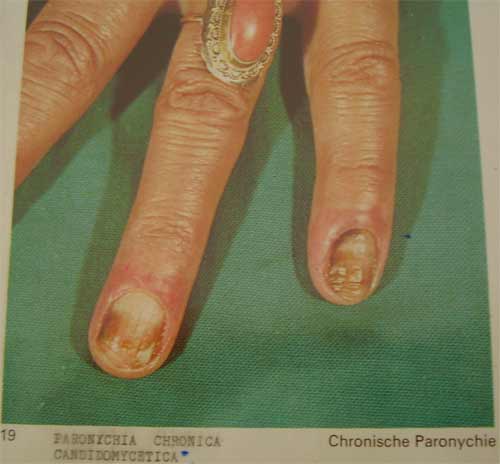 Paronychia chronica candidomycetica