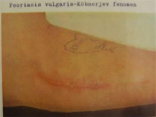 Psoriasis vulgaris - Kobnerjev fenomen