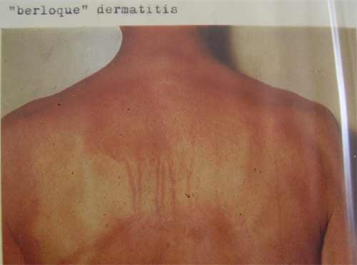 Berloque dermatitis