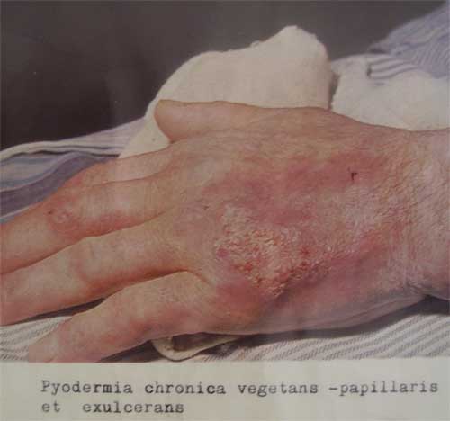 Pyodermia chronica vegetans - papillaris et exulcerans 