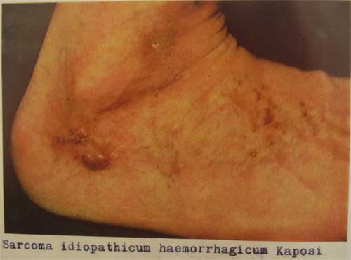 Sarcoma idiopathicum haemorrhagicum Kaposi 