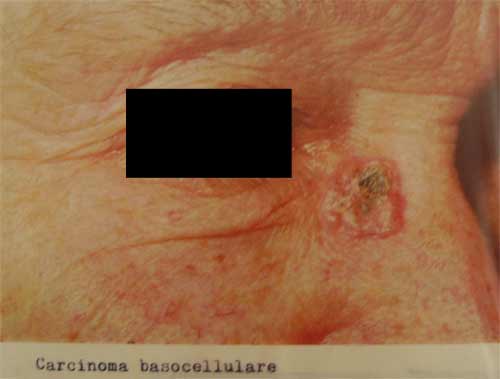 bazalnocelični karcinom