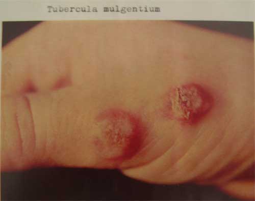 Tubercula mulgentium