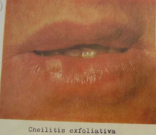 Cheilitis exfoliativa