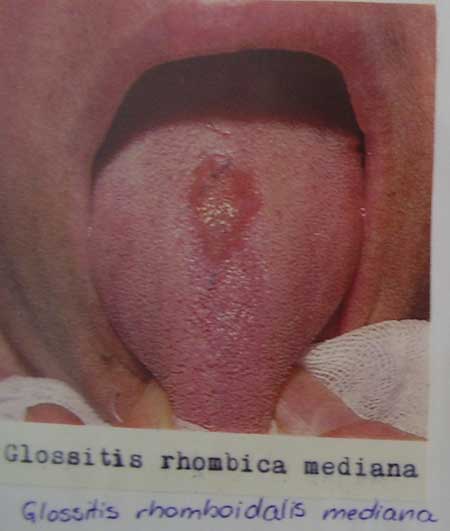 Glossitis rhomboidailis mediana