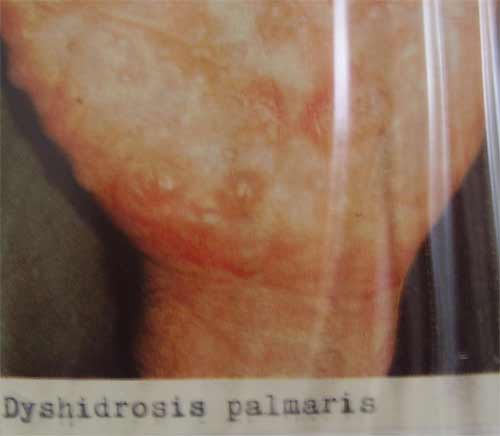 Dyshidrosis palmaris