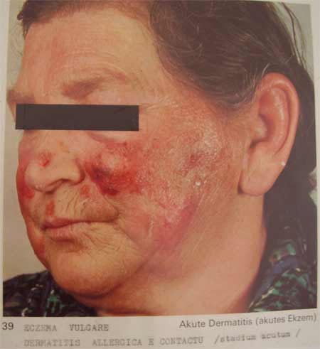 Eczema vulgare
