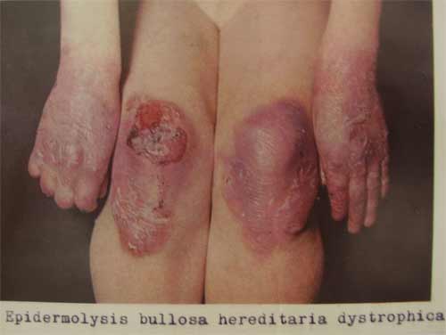 Epidermolysis bullosa hereditaria dystrophica 