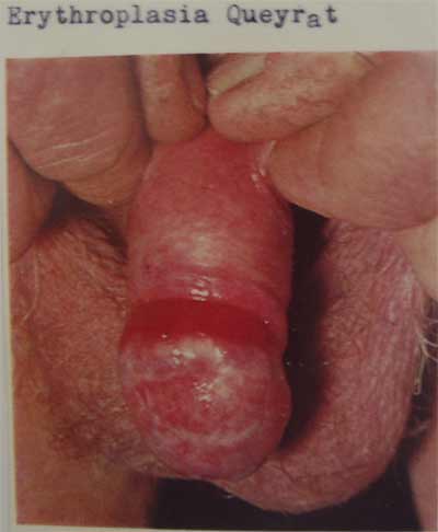 Erytoplasia Queyrat