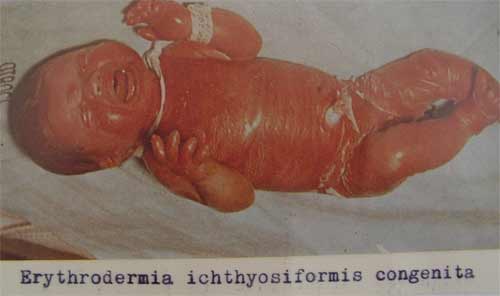 Erytrodermia ichthyosiformis congenita 