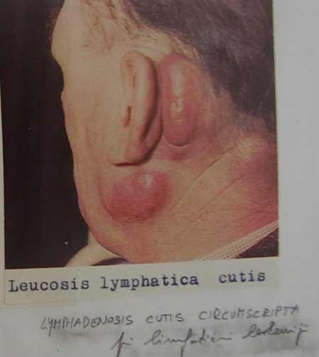 Leucosi lymphatica cutis